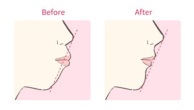 口を閉じている横顔の比較図